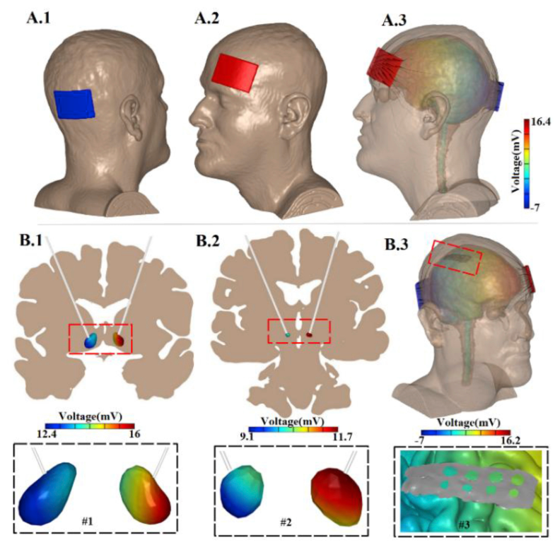 New Paper: Intracranial voltage recording during transcranial